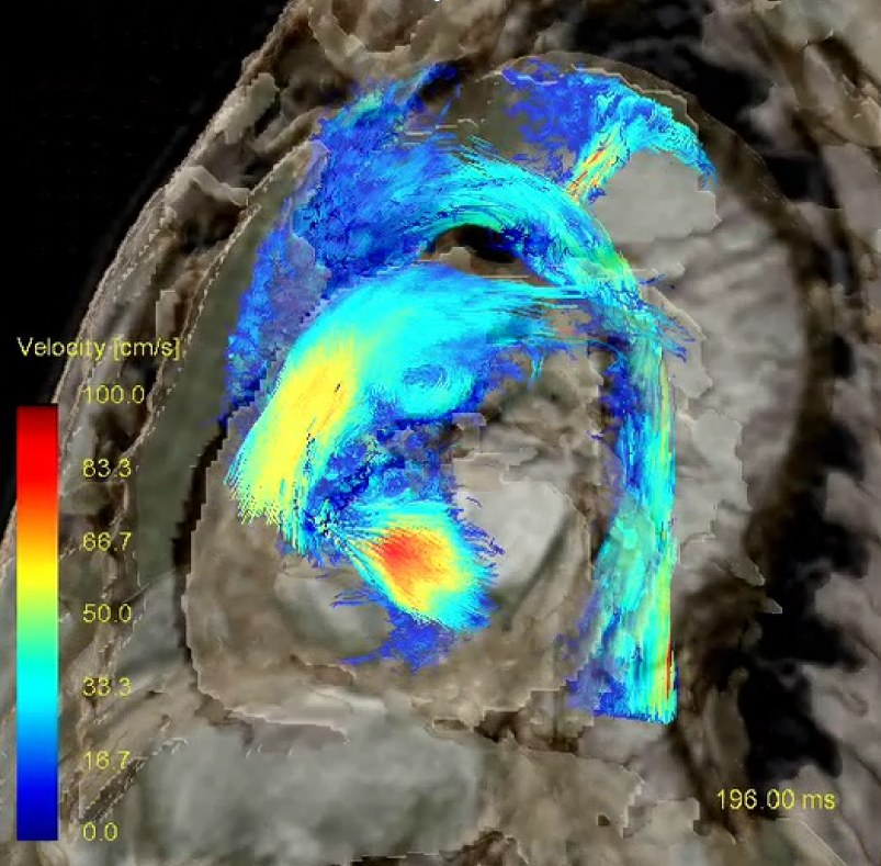 心臓内血流の4D Flow MRI（速度マップ）
